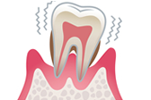 重度～末期歯周病